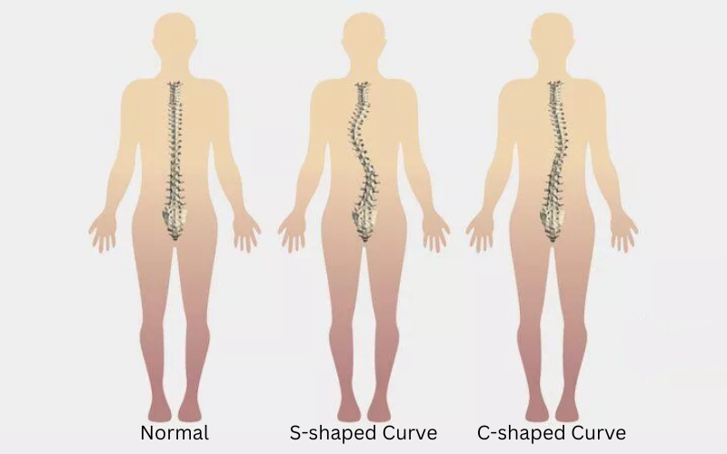 normal spine, s-shaped curved spine, and c-shaped curved spine